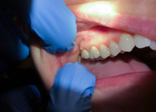 Best Emergency Root Canal Treatment in North Lynnwood, WA